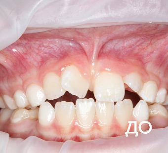 Исправление прикуса несъемными аппаратами и брекет-системой