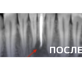 Лечение периодонтита
