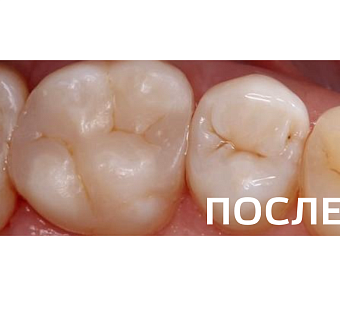 Лечение кариеса