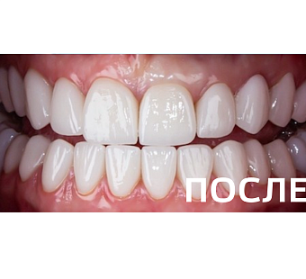 Восстановление эстетики улыбки и функции зубных рядов с помощью керамических коронок E.max
