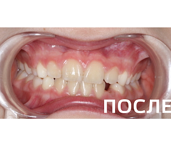 Исправление прикуса, выравнивание зубов