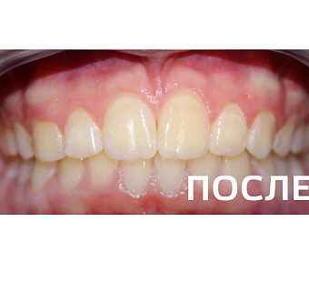 Исправление прикуса, выравнивание зубов