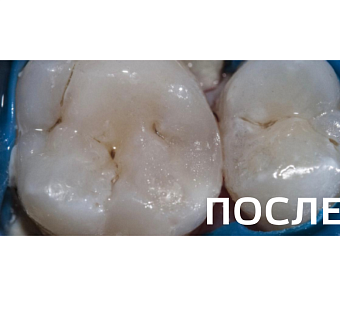 Лечение контактного кариеса