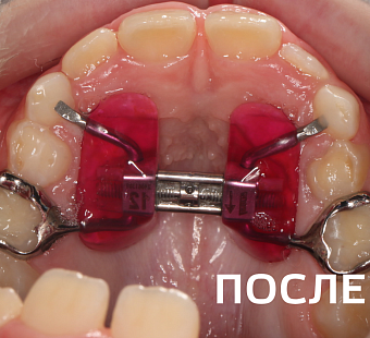 Исправление прикуса несъемными аппаратами