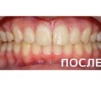 Исправление прикуса, выравнивание зубов