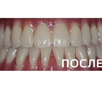 Восстановление зубного ряда полным съемным протезом