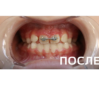 Исправление прикуса, выравнивание зубов