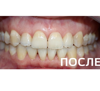 Исправление прикуса, выравнивание зубов