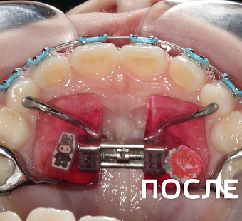 Исправление прикуса несъемными аппаратами и брекет-системой