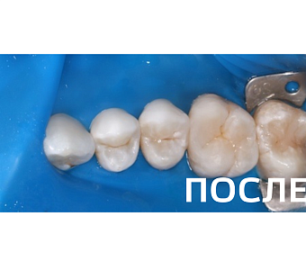 Лечение кариеса