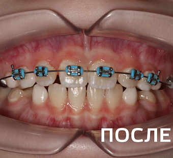 Исправление прикуса несъемными аппаратами и брекет-системой