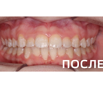 Исправление прикуса, выравнивание зубов