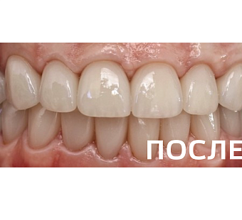 Ортопедическое восстановление зубов по методике All-on-6 