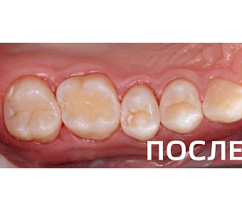 Лечение контактного кариеса