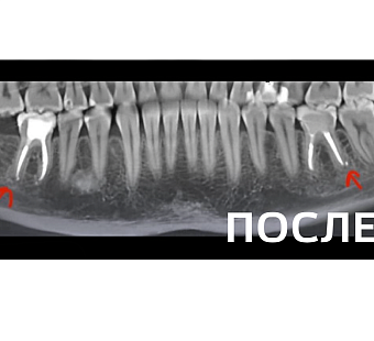 Лечение периодонтита
