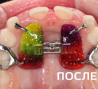 Исправление прикуса несъемными аппаратами