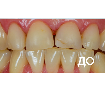 Реставрация зубов