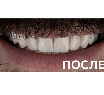 Восстановление эстетики улыбки с помощью керамических реставраций