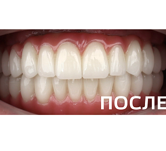 Метод "All-on-4"