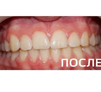 Исправление прикуса, выравнивание зубов