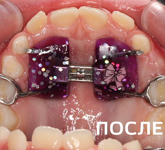 Исправление прикуса несъемными аппаратами