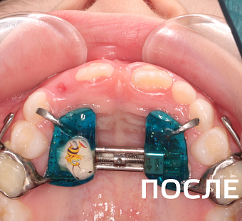 Исправление прикуса несъемными аппаратами