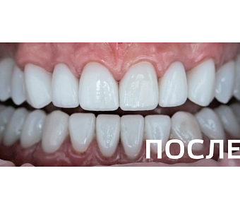 Комплексное ортопедическое восстановление зубных рядов 