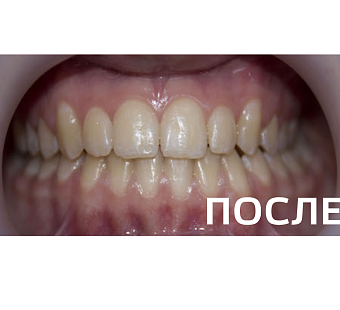 Исправление прикуса, выравнивание зубов