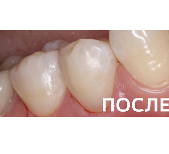  Лечение клиновидных дефектов