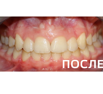 Исправление прикуса, выравнивание зубов
