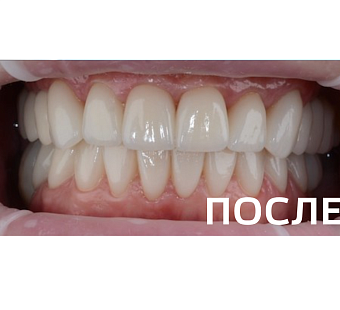 Комплексное восстановление зубных рядов керамическими винирами,  керамическими коронками  с опорой на зубы и импланты