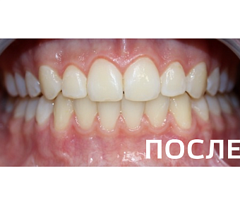 Исправление прикуса, выравнивание зубов