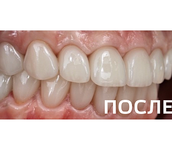 Ортопедическое восстановление зубов по методике All-on-6 