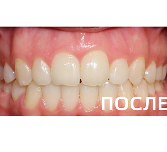 Исправление прикуса, выравнивание зубов