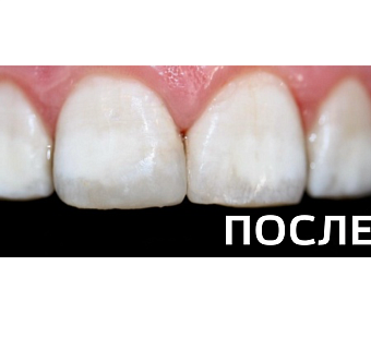 Реставрация  резца после травматического скола