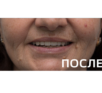 Ортопедическое восстановление зубов по методике All-on-6