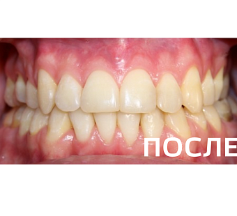 Исправление прикуса, выравнивание зубов
