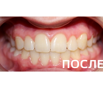Исправление прикуса, выравнивание зубов
