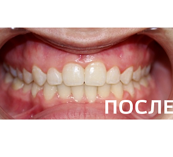 Исправление прикуса, выравнивание зубов