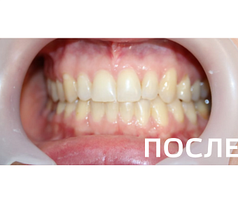 Исправление прикуса, выравнивание зубов