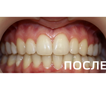 Исправление прикуса, выравнивание зубов