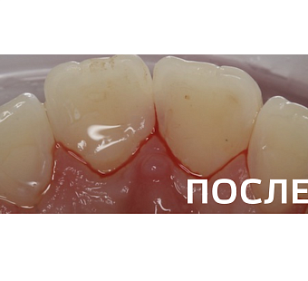 Лечение кариеса дентина