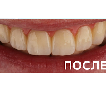 Восстановление зубных рядов методом  All-on-4