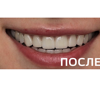 Комплексное ортопедическое восстановление зубных рядов 