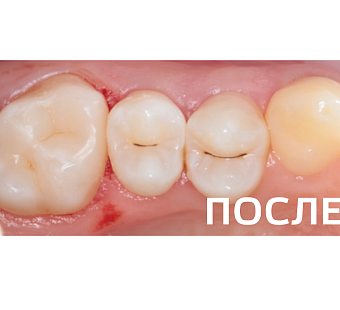 Лечение кариеса 