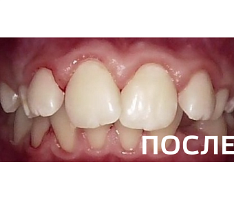 Профгигиена полости рта