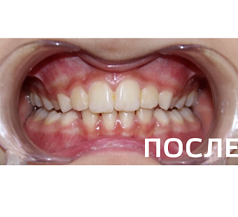 Исправление прикуса, выравнивание зубов