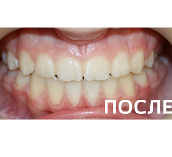 Исправление прикуса, выравнивание зубов