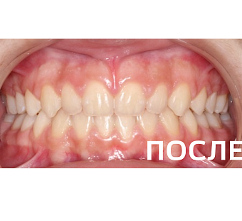 Исправление прикуса, выравнивание зубов