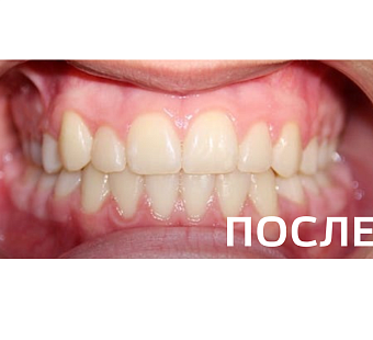 Исправление прикуса, выравнивание зубов